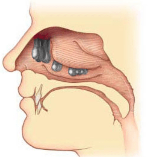 سليلة أنفية