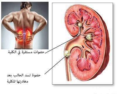 حصوات الكلية و الحالب