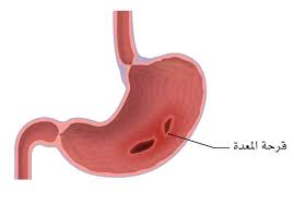 قرحة المعدة